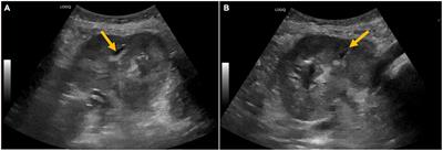 Case report: Emphysematous pyelonephritis associated with kidney allograft abscess formation